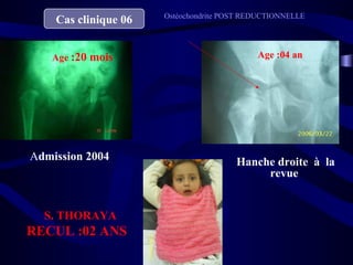Cas clinique 06
Admission 2004 Hanche droite à la
revue
Age :20 mois Age :04 an
S. THORAYA
RECUL :02 ANS
Ostéochondrite POST REDUCTIONNELLE
 