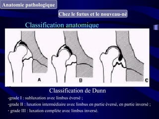 Anatomie pathologique
Chez le fœtus et le nouveau-né
Classification anatomique
Classification de Dunn
-grade I : subluxation avec limbus éversé ;
-grade II : luxation intermédiaire avec limbus en partie éversé, en partie inversé ;
- grade III : luxation complète avec limbus inversé.
 