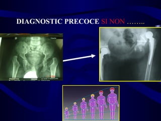 DIAGNOSTIC PRECOCE SI NON ……..
 