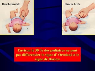 Environ le 30 % des pediatres ne peutEnviron le 30 % des pediatres ne peut
pas differencier le signe d’ Ortolani et lepas differencier le signe d’ Ortolani et le
signe de Barlowsigne de Barlow
 