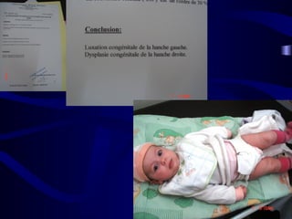 La luxation congénitale de la hanche