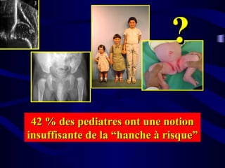42 % des pediatres ont une notion42 % des pediatres ont une notion
insuffisante de la “hanche à risque”insuffisante de la “hanche à risque”
??
 