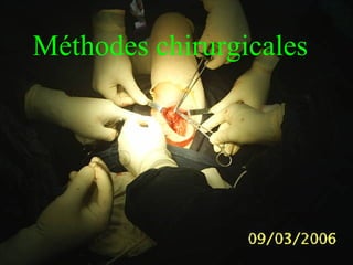 Méthodes chirurgicales
 