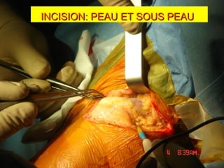 INCISION: PEAU ET SOUS PEAUINCISION: PEAU ET SOUS PEAU
 