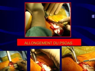 ALLONGEMENT DU PSOASALLONGEMENT DU PSOAS
 