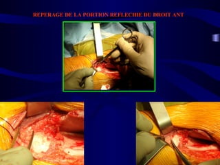 REPERAGE DE LA PORTION REFLECHIE DU DROIT ANT
 