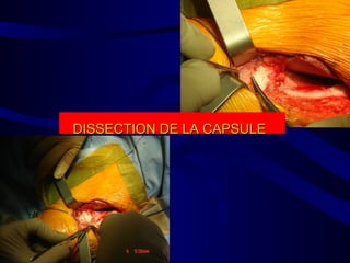 DISSECTION DE LA CAPSULEDISSECTION DE LA CAPSULE
 