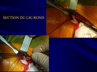 SECTION DU LIG ROND
 
