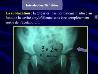 Introduction/Définition
La subluxation : la tête n’est pas normalement située au
fond de la cavité cotyloïdienne sans être complètement
sortie de l’acétabulum.
 