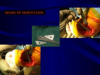 DEGRE DE DEROTATION
 
