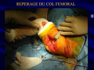 REPERAGE DU COL FEMORAL
 
