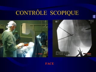 CONTRÔLE SCOPIQUE
FACE
 