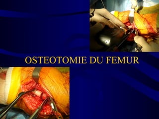 OSTEOTOMIE DU FEMUR
 