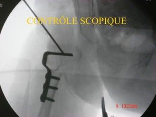 CONTRÔLE SCOPIQUE
 