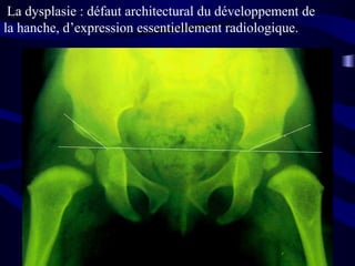 La dysplasie : défaut architectural du développement de
la hanche, d’expression essentiellement radiologique.
 