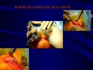 SUTURE DU CARTILAGE DE LA CRETE
 