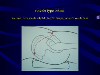 voie de type bikini
incision 1 cm sous le relief de la crête iliaque, incurvée vers le haut
 