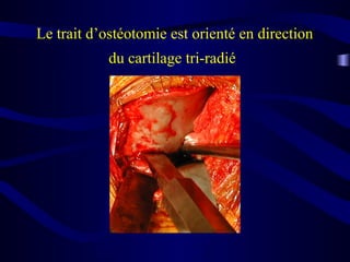 Le trait d’ostéotomie est orienté en direction
du cartilage tri-radié
 
