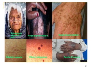 Wrinkling &
sagging of
skin
13
Hypopigmentation Hyperpigmentation
Dilated vessels Cherry Angioma Senile Purpura
 