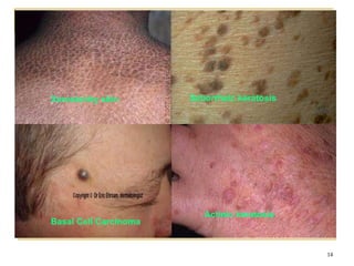 Xerosis/dry skin
14
Seborrheic keratosis
Actinic keratosis
Basal Cell Carcinoma
 