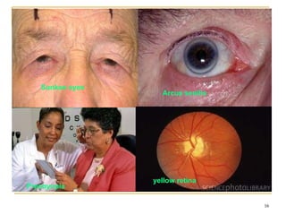 Sunken eyes
16
Arcus senilis
Presbyopia
yellow retina
 