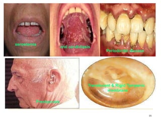 xerostomia
19
oral candidiasis
Periodontal disease
Presbycusis
Translucent & Rigid Tympanic
membrane
 