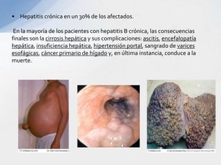 • Hepatitis crónica en un 30% de los afectados.
En la mayoría de los pacientes con hepatitis B crónica, las consecuencias
finales son la cirrosis hepática y sus complicaciones: ascitis, encefalopatía
hepática, insuficiencia hepática, hipertensión portal, sangrado de varices
esofágicas, cáncer primario de hígado y, en última instancia, conduce a la
muerte.
 
