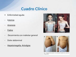 Cuadro Clínico
• Enfermedad aguda:
- Ictericia
- Anorexia
- Fiebre
- Decaimiento con malestar general
- Dolor abdominal
- Hepatomegalia, Artralgias
 