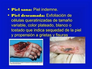 • Piel sana: Piel indemne. 
• Piel descamada: Exfoliación de 
células queratinizadas de tamaño 
variable, color plateado, blanco o 
tostado que indica sequedad de la piel 
y propensión a grietas y fisuras. 
 