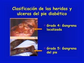 Clasificación de las heridas y 
ulceras del pie diabético 
Grado 4: Gangrena 
localizada 
Grado 5: Gangrena 
del pie 
 