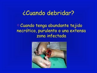 ¿Cuando debridar? 
Cuando tenga abundante tejido 
necrótico, purulento o una extensa 
zona infectada 
 