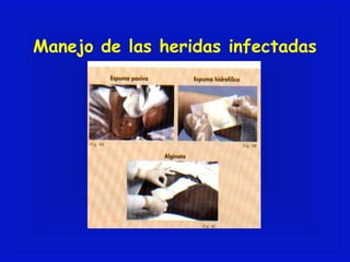 Manejo de las heridas infectadas 
 