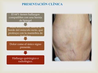 PRESENTACIÓN CLÍNICA
El 64% tienen hallazgos
compatibles con una hernia
de Spiegel
Masa abdominal, lateral al
borde del músculo recto, que
protruye con la maniobra de
Valsalva
Dolor como el único signo
presente.
Hallazgo quirúrgico o
radiológico.
 