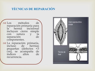 TÉCNICAS DE REPARACIÓN
 Los métodos de
reparación primaria para
la hernia incisional
incluyen cierre simple
con sutura y la
separación de
componentes.
 La reparación primaria,
incluso de hernias
pequeñas (defectos <3
cm), se acompaña de
índices altos de
recurrencia.
 