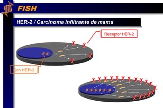 FISH
HER-2 / Carcinoma infiltrante de mama
Gen HER-2
Receptor HER-2Receptor HER-2
 