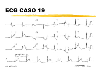 ECG CASO 19 
