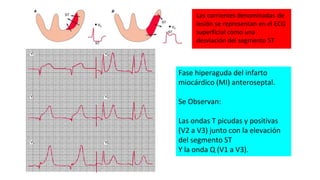 Fase hiperaguda del infarto
miocárdico (MI) anteroseptal.
Se Observan:
Las ondas T picudas y positivas
(V2 a V3) junto con la elevación
del segmento ST
Y la onda Q (V1 a V3).
 