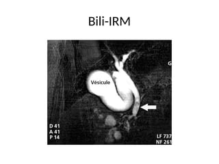 Bili-IRM
 