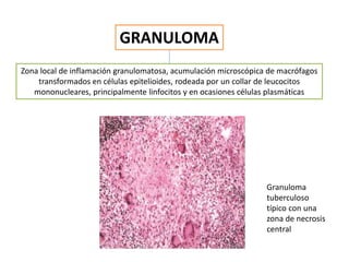 Zona local de inflamación granulomatosa, acumulación microscópica de macrófagos
transformados en células epitelioides, rodeada por un collar de leucocitos
mononucleares, principalmente linfocitos y en ocasiones células plasmáticas
Granuloma
tuberculoso
típico con una
zona de necrosis
central
 