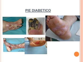 PIE DIABETICO
 