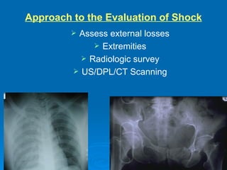 Approach to the Evaluation of Shock Assess external losses Extremities Radiologic survey US/DPL/CT Scanning 