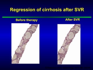 D’Ambrosio et al. Hepatology 2012; 56: 532-43
Before therapy After SVR
Regression of cirrhosis after SVR
 