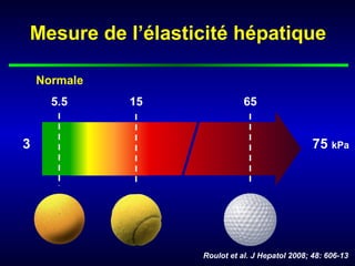 Mesure de l’élasticité hépatique
75 kPa3
15 655.5
Normale
Roulot et al. J Hepatol 2008; 48: 606-13
 