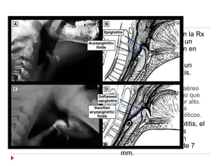  A) Epiglotis normal en la Rx
lateral de cuello, con un
dibujo de dicha región en
cuadro B.
 En los cuadros C yD un
paciente con epiglotitis.
 Pérdida del espacio aéreo
vallecular, un hallazgo que
puede ser pasado por alto.
Engrosamiento de los
pliegues aritenoepiglóticos.
 En adultos con epiglotitis, el
ancho de los pliegues
aritenoepiglóticos son
usualmente de más de 7
mm.
 