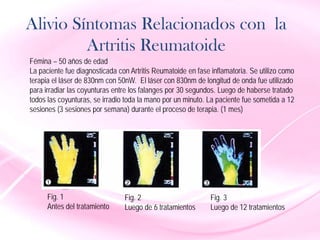 Alivio Síntomas Relacionados con la
Artritis Reumatoide
Fémina – 50 años de edad
La paciente fue diagnosticada con Artritis Reumatoide en fase inflamatoria. Se utilizo como
terapia el láser de 830nm con 50nW. El láser con 830nm de longitud de onda fue utilizado
para irradiar las coyunturas entre los falanges por 30 segundos. Luego de haberse tratado
todos las coyunturas, se irradio toda la mano por un minuto. La paciente fue sometida a 12
sesiones (3 sesiones por semana) durante el proceso de terapia. (1 mes)
Fig. 1
Antes del tratamiento
Fig. 2
Luego de 6 tratamientos
Fig. 3
Luego de 12 tratamientos
 