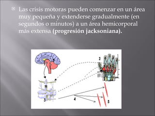 Las crisis motoras pueden comenzar en un área muy pequeña y extenderse gradualmente (en segundos o minutos) a un área hemicorporal más extensa  (progresión jacksoniana).  
