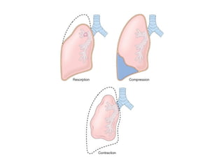 Lecture 28. common repratory pathological condirtion part 3