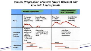 Clinical Progression of Icteric (Weil’s Disease) and
Anicteric Leptospirosis
(pigmented
part of eye)
 