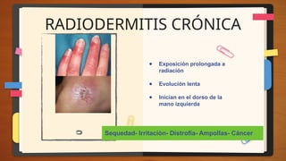 RADIODERMITIS CRÓNICA
● Exposición prolongada a
radiación
● Evolución lenta
● Inician en el dorso de la
mano izquierda
Sequedad- Irritaciòn- Distrofia- Ampollas- Cáncer
 