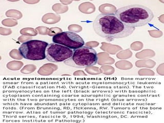 leukemias.ppt